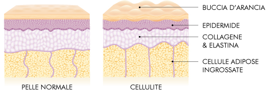 cellulite