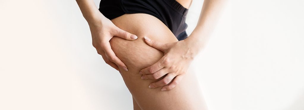 Cellulite: cause e trattamenti - Pavaglione Integratori